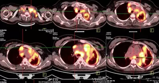 Mesothelioma symptoms: Early and late symptoms of mesothelio